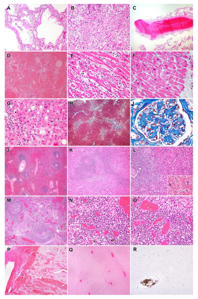 Representative findings in patients in the COVID-19 cohort. A. Lung, Subject P22. Exudative phase diffuse alveolar damage with hyaline membranes and mild interstitial inflammation (H&E, 100x). B. Lung, Subject P26. Proliferative phase diffuse alveolar damage and sparse inflammation. (H&E, 200x). C. Lung, Subject P22. Organizing thrombus in medium sized pulmonary artery. (H&E, 40x). D. Lung, Subject P28. Diffuse pulmonary hemorrhage. (H&E, 100x). E. Heart, Subject P3. Active lymphocytic myocarditis with cardiomyocyte necrosis. (H&E, 400x). F. Heart, Subject P38. Microscopic focus of bland myocardial contraction band necrosis. (H&E, 400x). G. Liver, Subject P41. Steatohepatitis with mild steatosis and scattered ballooned hepatocytes. (H&E, 400x), H. Liver, Subject P41. Focal bridging fibrosis involving central hepatic veins. (Masson trichrome, 40x). I. Kidney, Subject P16. Nodular glomerulosclerosis. (Masson trichrome, 600x). J. Spleen, Subject P16. Preservation of white pulp and congestion (H&E, 40x) K. Spleen, Subject P14. Lymphoid depletion of white pulp with proteinaceous material and red pulp congestion. (H&E, 100x) L. Spleen, Subject P34. Relative preservation of white pulp with extramedullary hematopoiesis (inset) in red pulp (H&E, 200x) M. Lymph node, Subject P25. Follicular hyperplasia with well-defined follicles. (H&E) N. Lymph node, Subject P25. Marked plasmacytosis in the medullary cord. (H&E, 400x) O. Lymph node, Subject P25. Marked plasmacytosis and sinus histiocytosis. (H&E, 400x) P. Brain, Subject P35, Focal subarachnoid and intraparenchymal hemorrhage. (H&E, 40x) Q. Brain, Subject P44, Vascular congestion. (H&E, 40x) R. Brain, Subject P43, Intravascular platelet aggregates. (anti-CD61 stain, 100x) Photo: Chertow, et al., 2021 / NIH / Nature