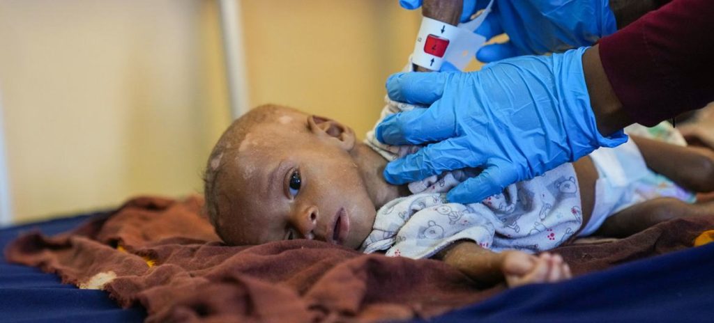 Eight-month-old Ibrahim, who is suffering from malnutrition, has his arm circumference measured by a doctor at a hospital in Mogadishu, Somalia. Photo: Omid Fazel / UNICEF